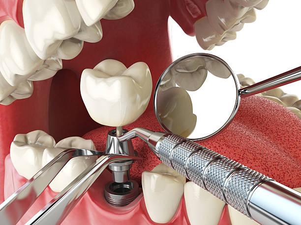 Best Emergency Treatment for Dental Infections or Abscesses in East Farmingdale, NY